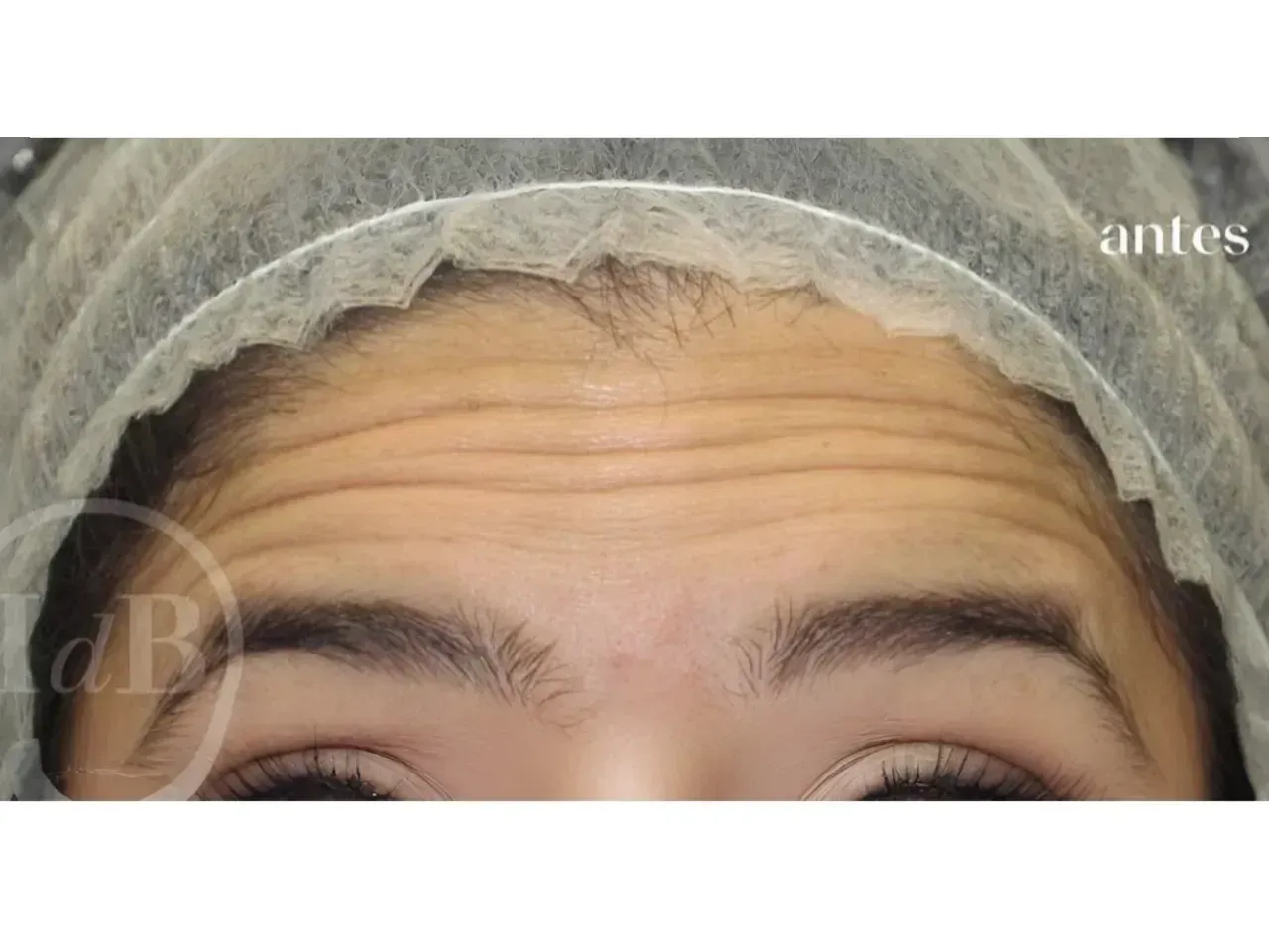 tratamiento para eliminar arrugas en la frente con medicina estética