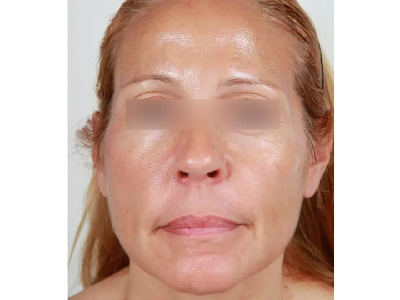 Después del tratamiento de rejuvenecimiento Facial con medicina estética