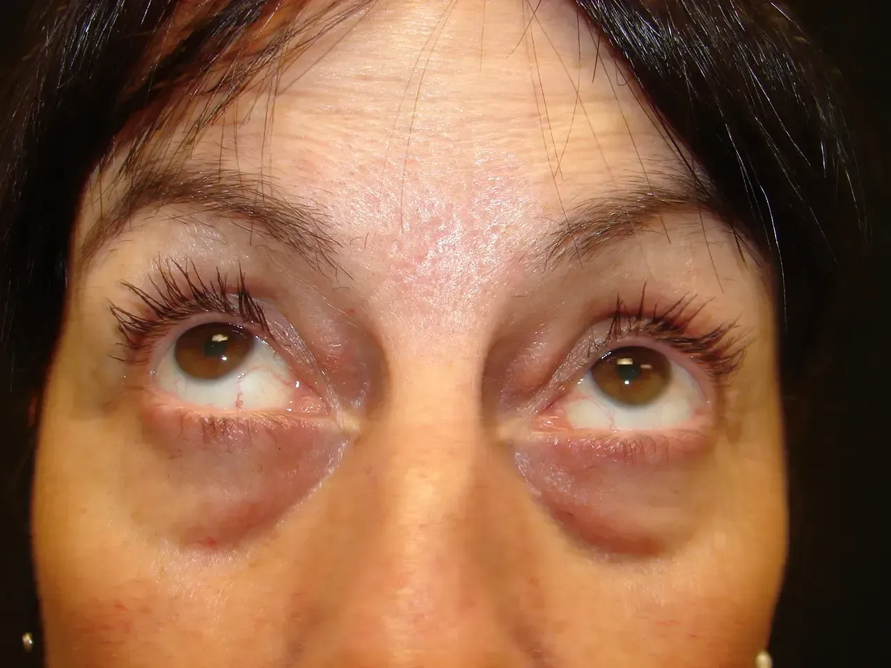 Paciente antes de ser operado de una blefaroplastia