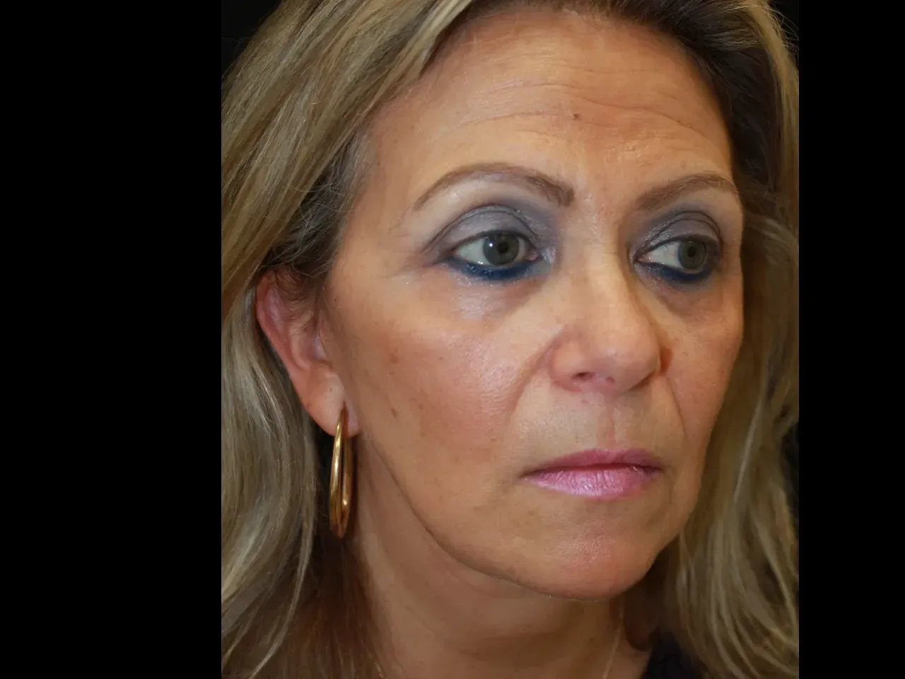 Foto de Dasi después del linfting facial
