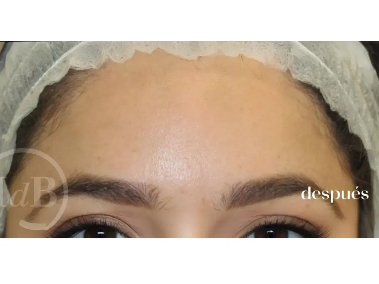 tratamiento para eliminar arrugas en la frente con medicina estética