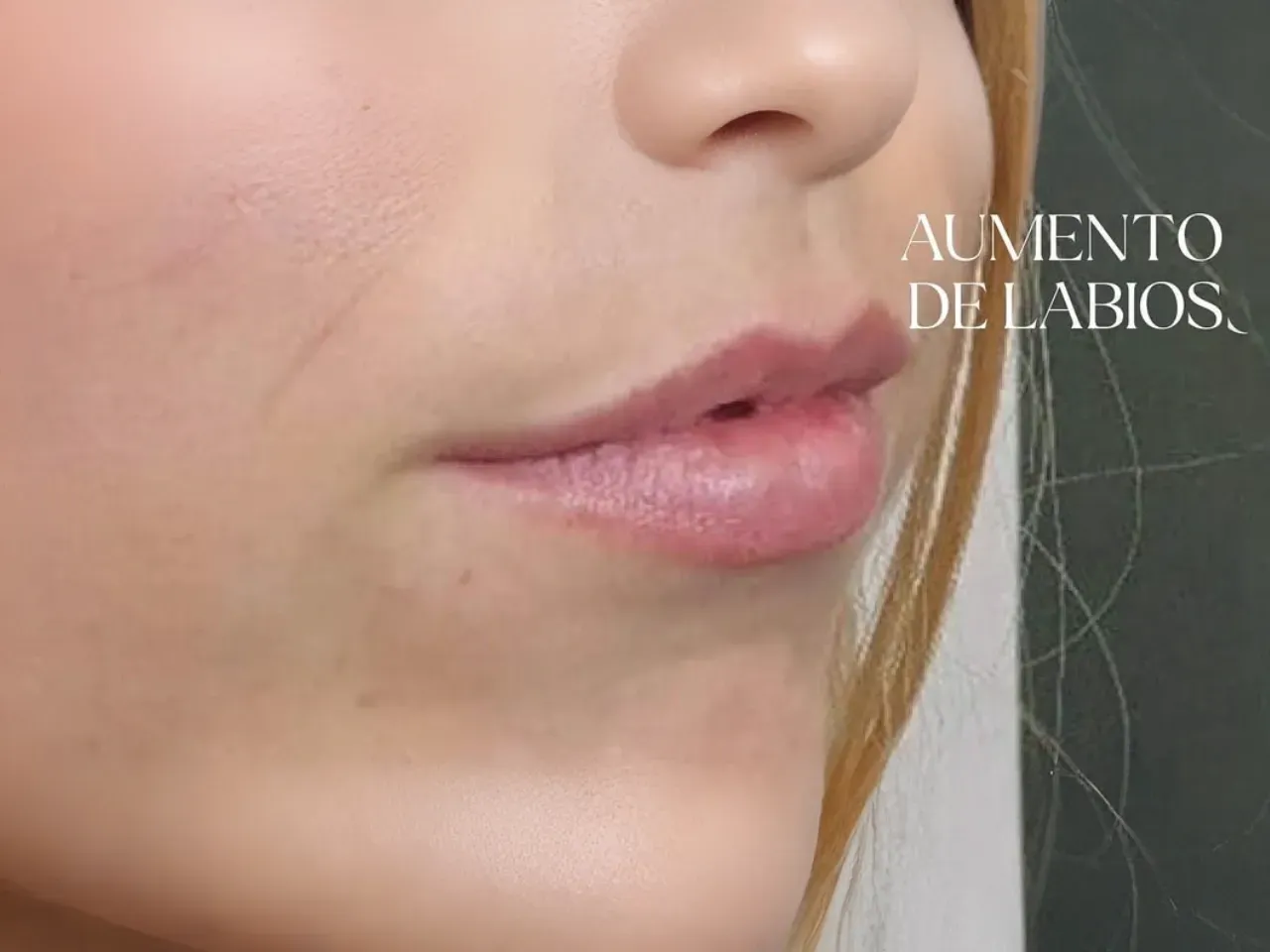 Después: Lip augmentation, Cupid's bow ✨