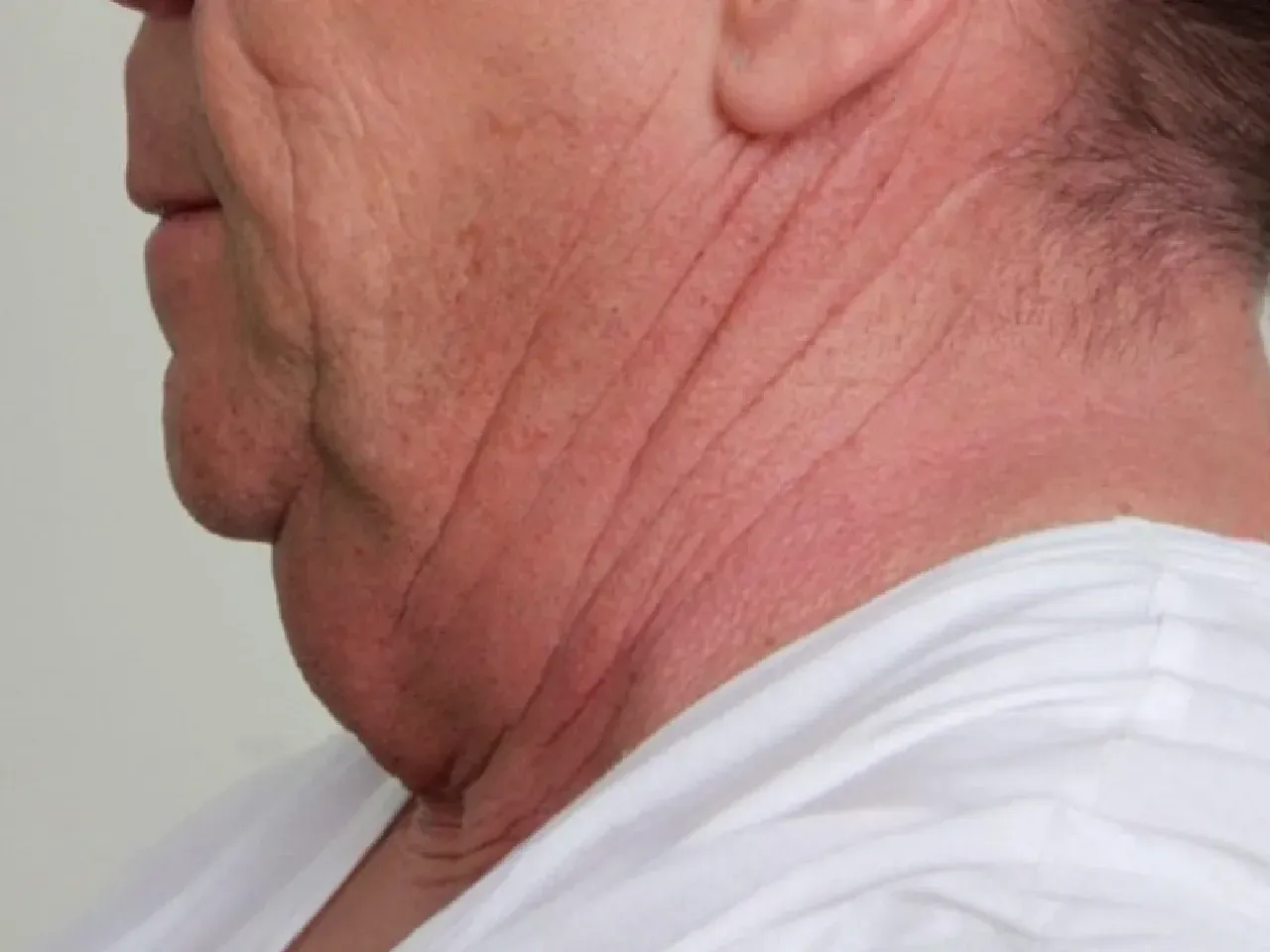 Antes de la cirugía de lifting de cuello
