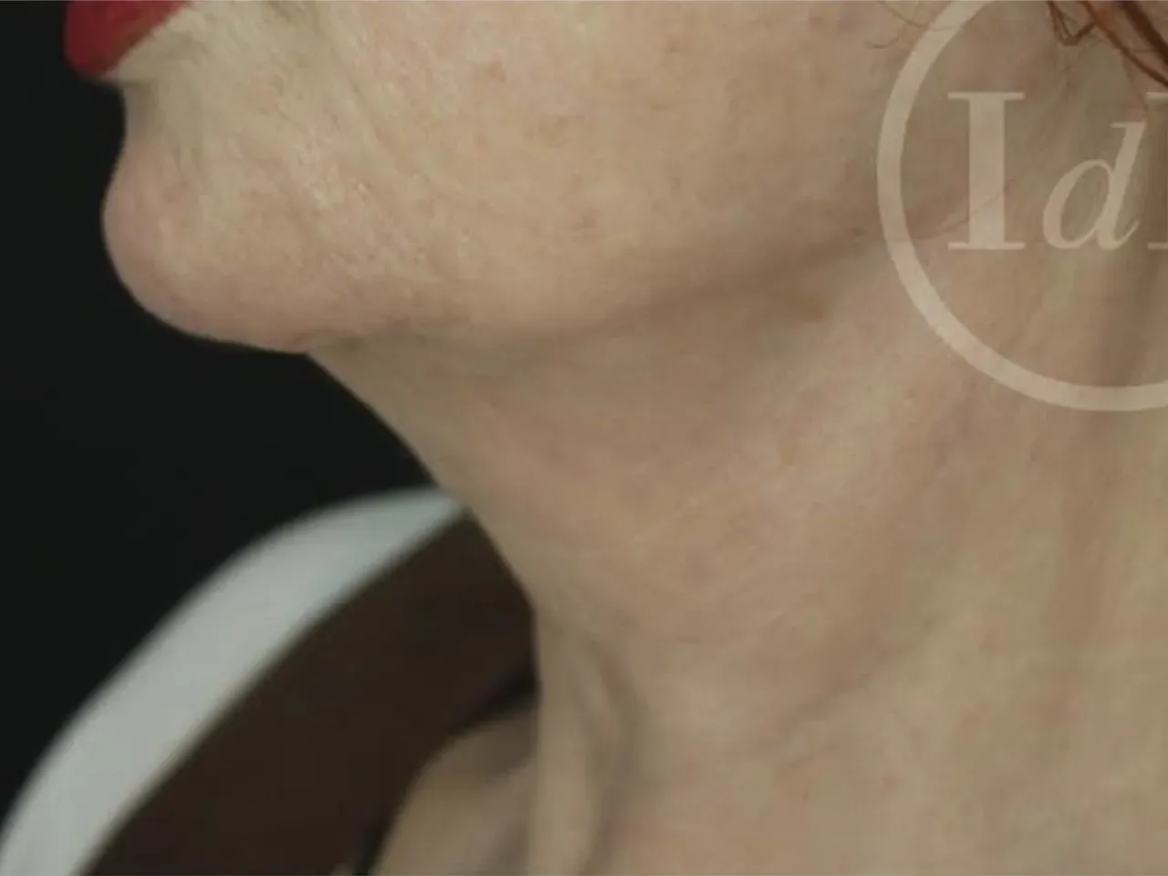Paciente mujer después de lifting de cuello