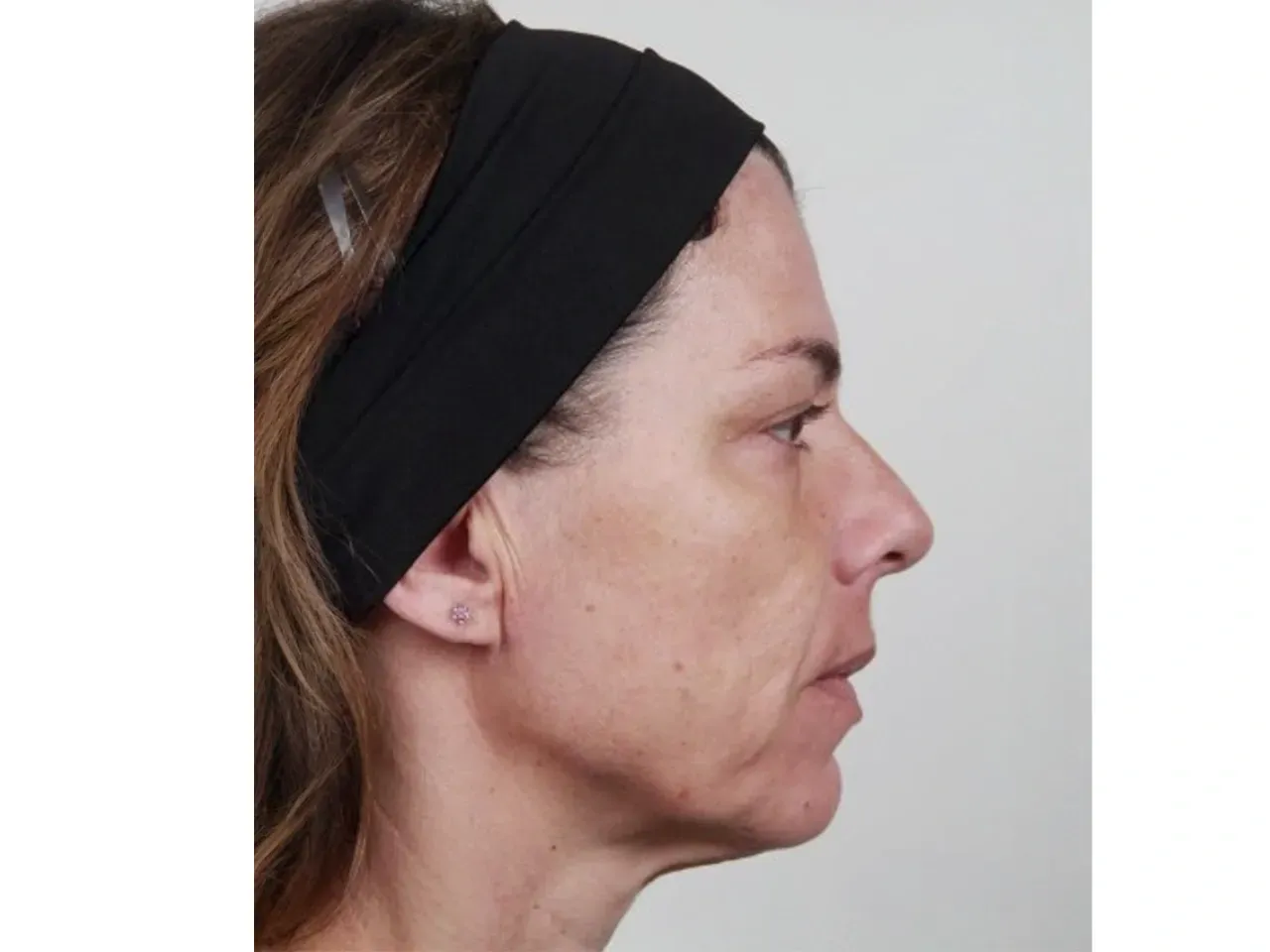Antes del tratamiento facial de rejuvenecimiento con acido hialurónico