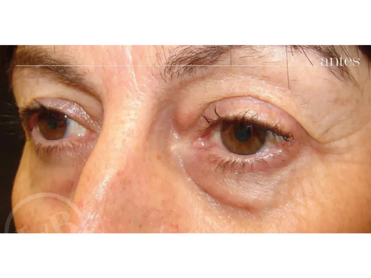 Resultado de una blefaroplastia inferior