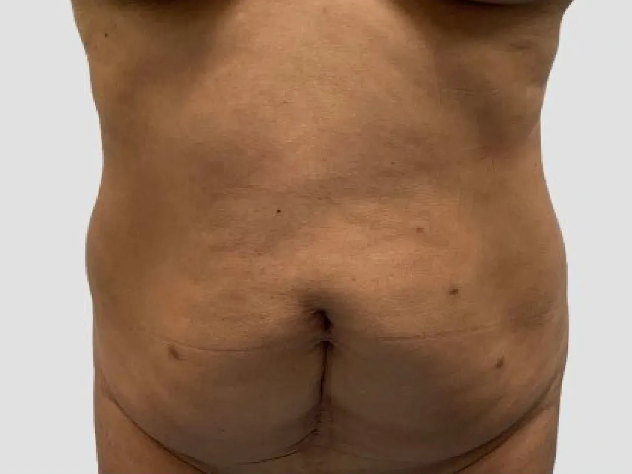 dermolipectomía antes de ser operada