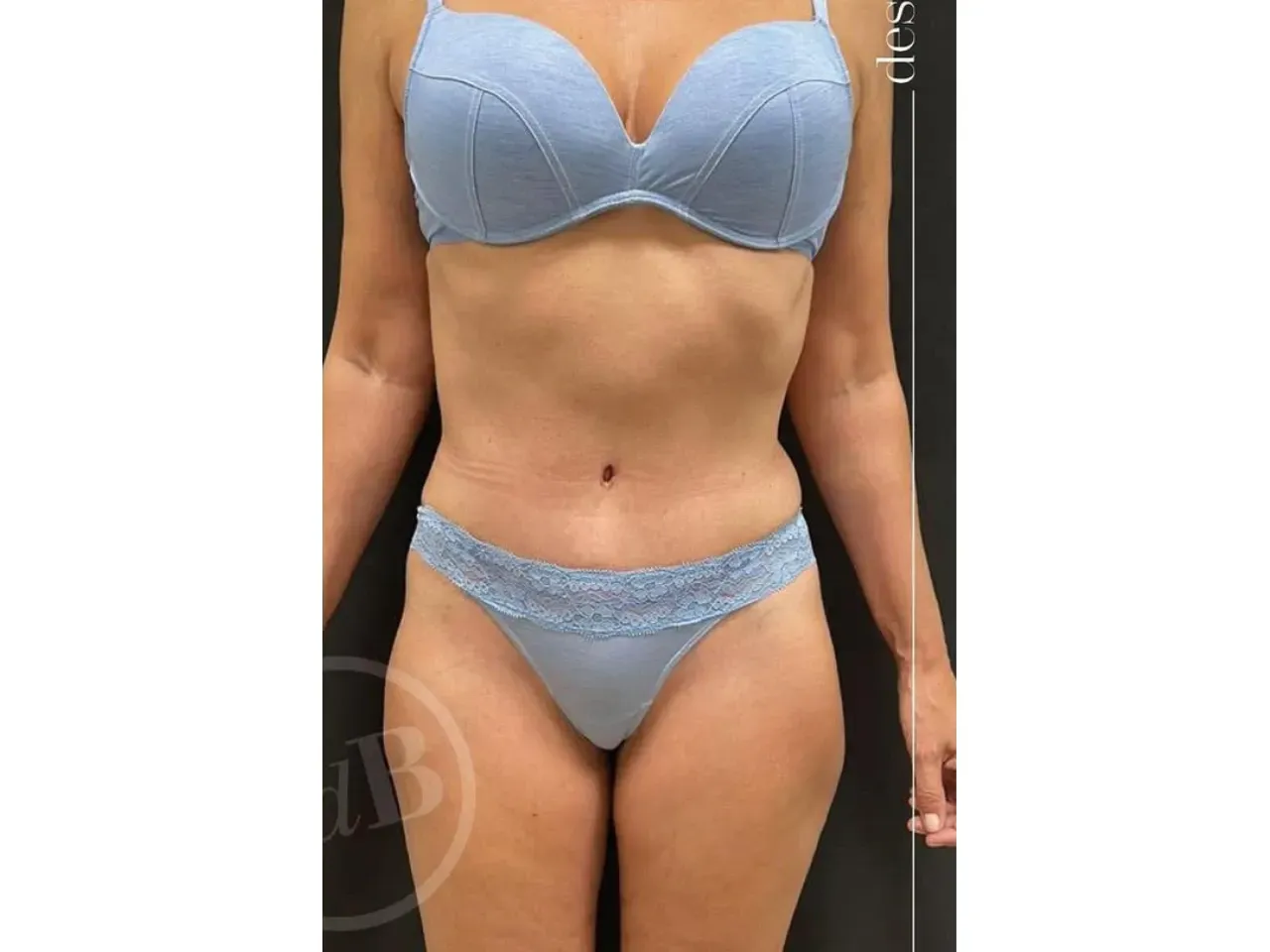 Antes: Tummy tuck (abdominoplasty)