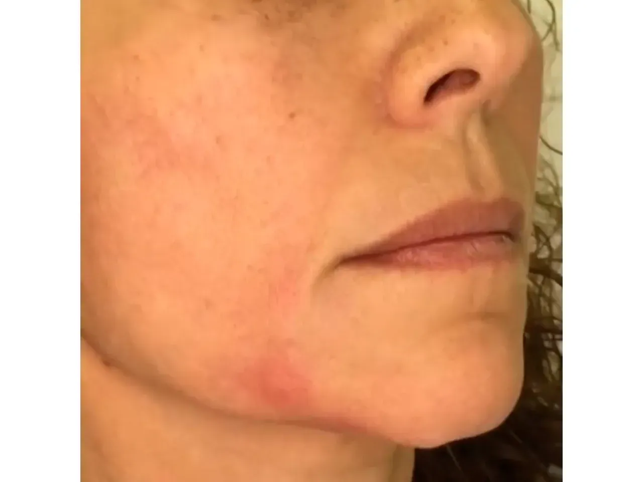 Rejuvenecimiento Facial con medicina estética