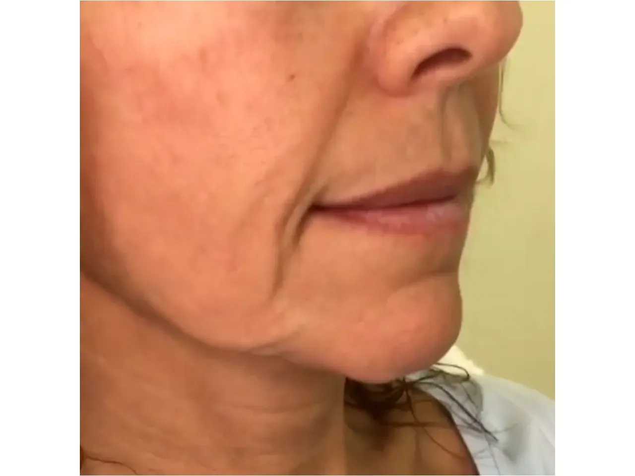 Rejuvenecimiento Facial con medicina estética