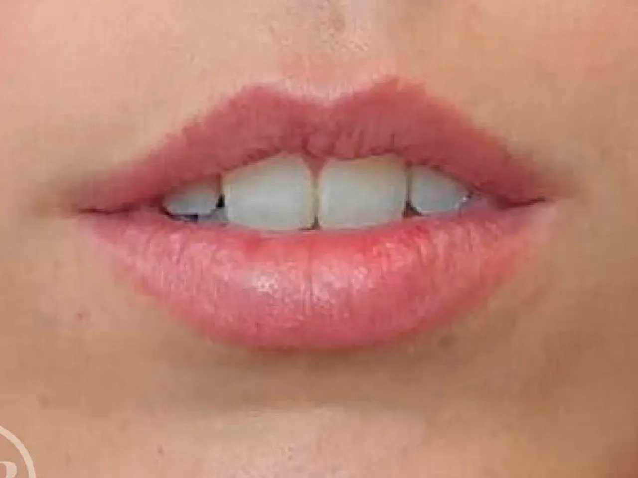 Aumento de labios estilo russian lips arco de cupido