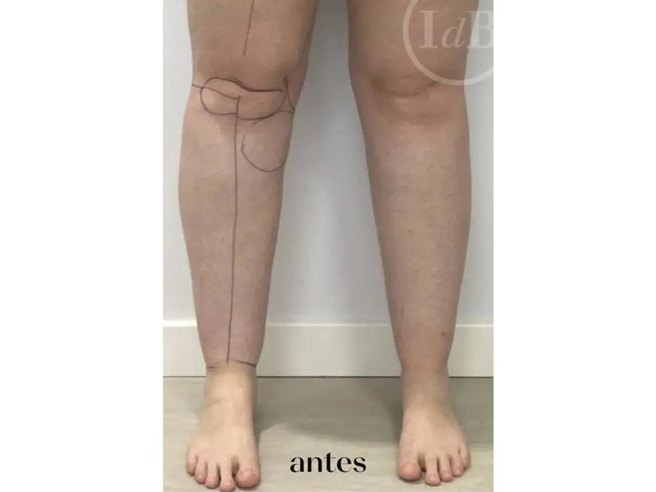 Piernas de lipedema antes de la operación