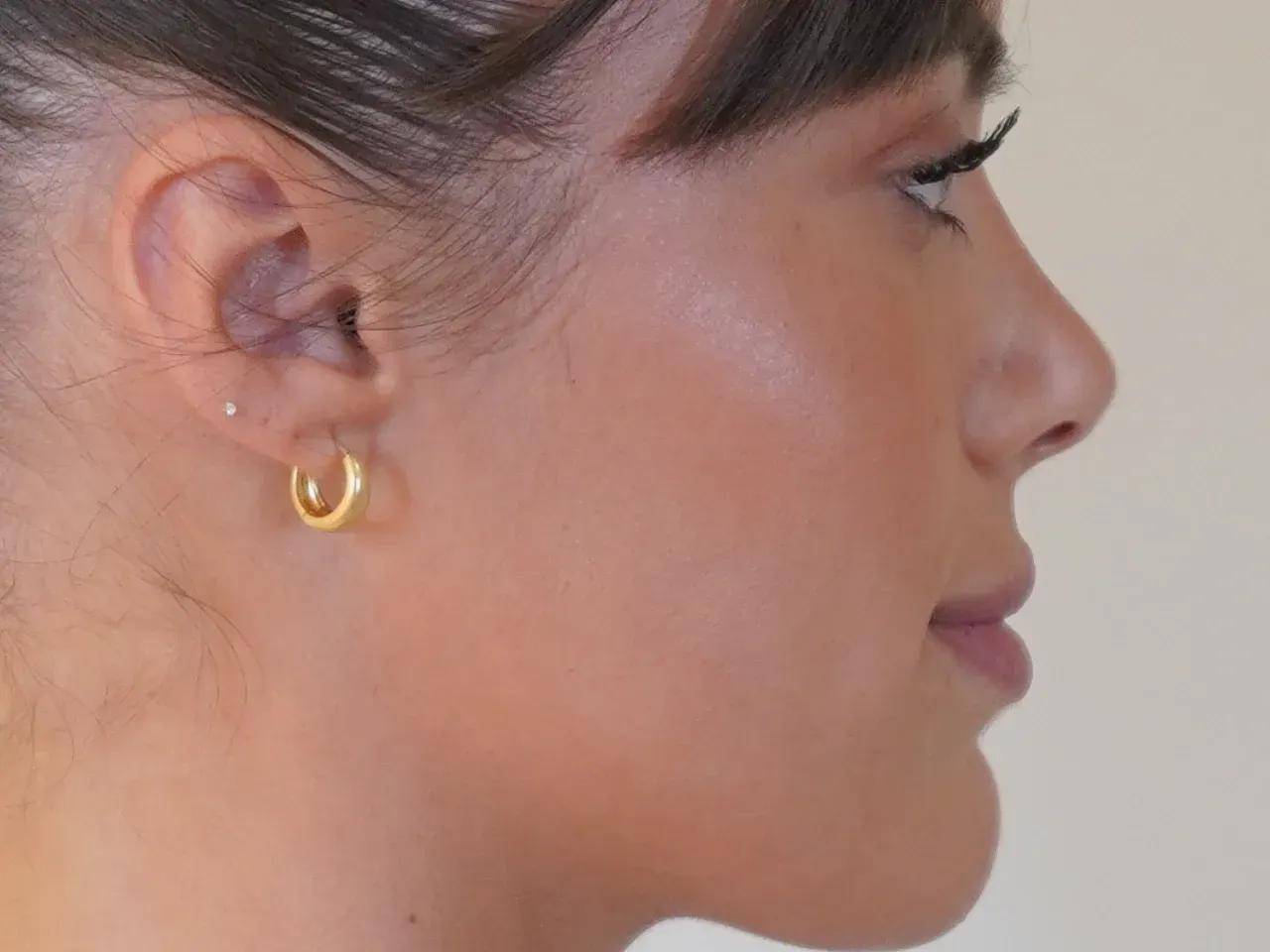 tratamiento de armonización facial y aumento de labios de Andrea Canel de la LIDLT