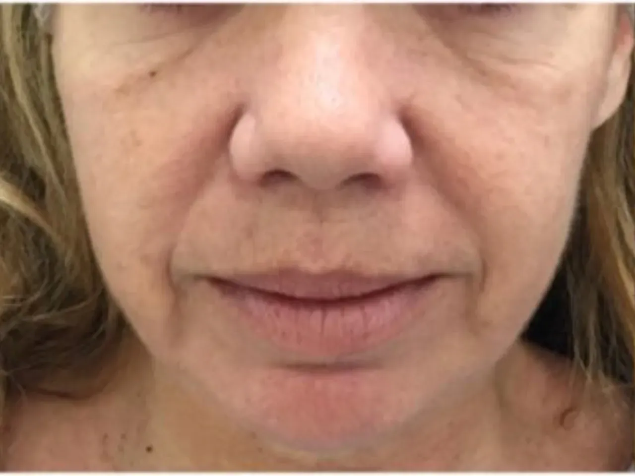 Antes del tratamiento facial de ultherapy