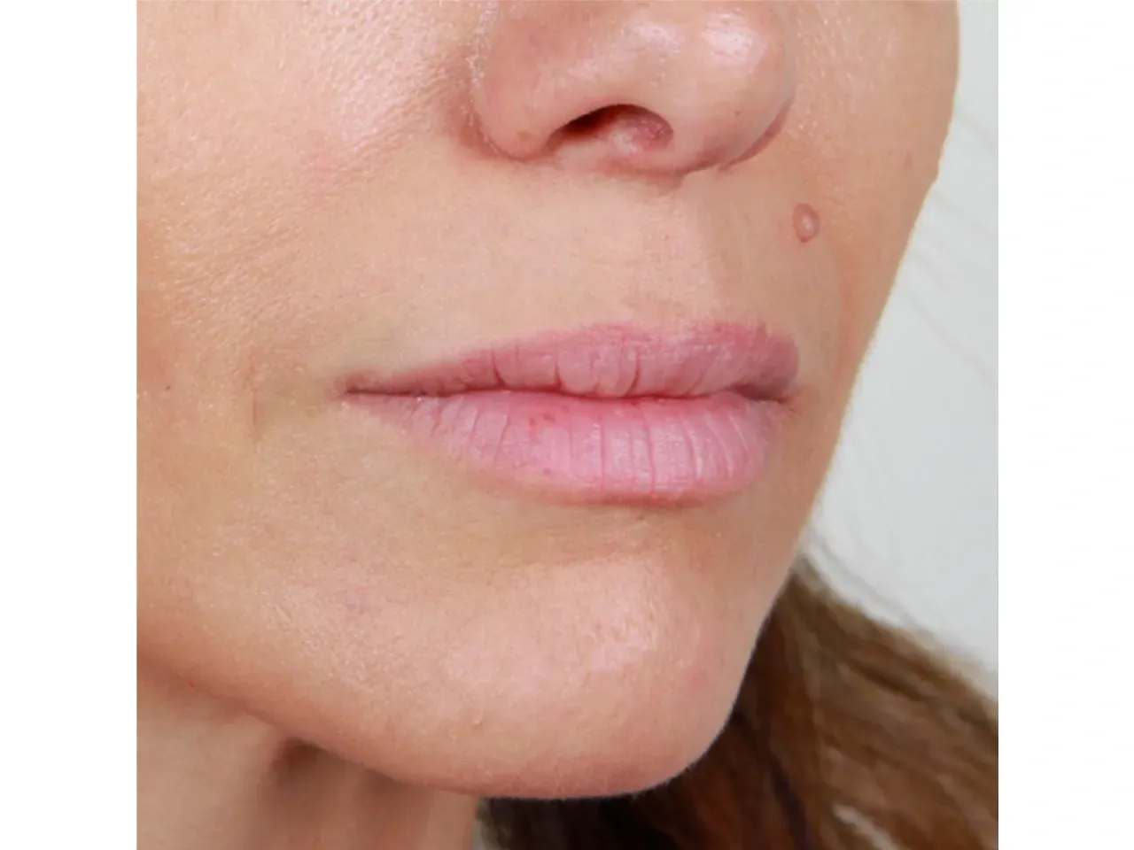 Aumento de labios sútil con ácido hialurónico