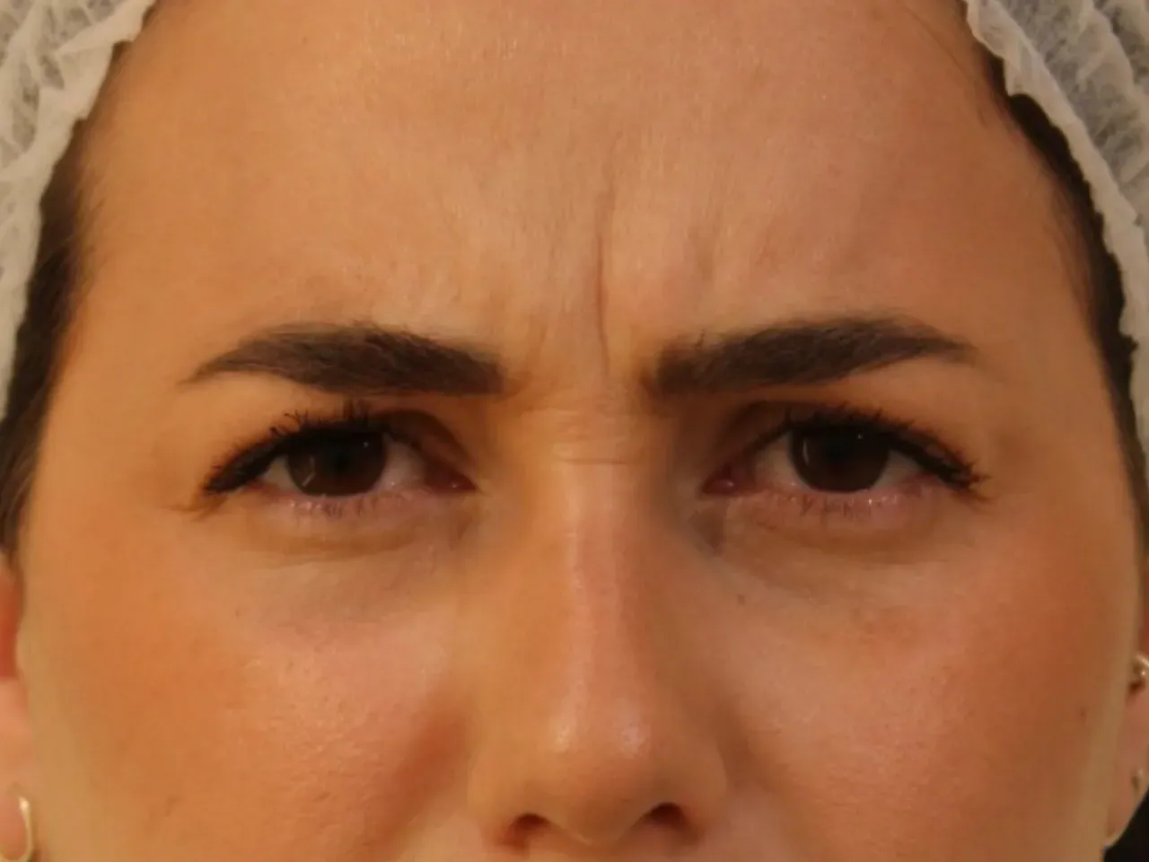 Arrugas del entrecejo antes de tratamiento con medicina estética