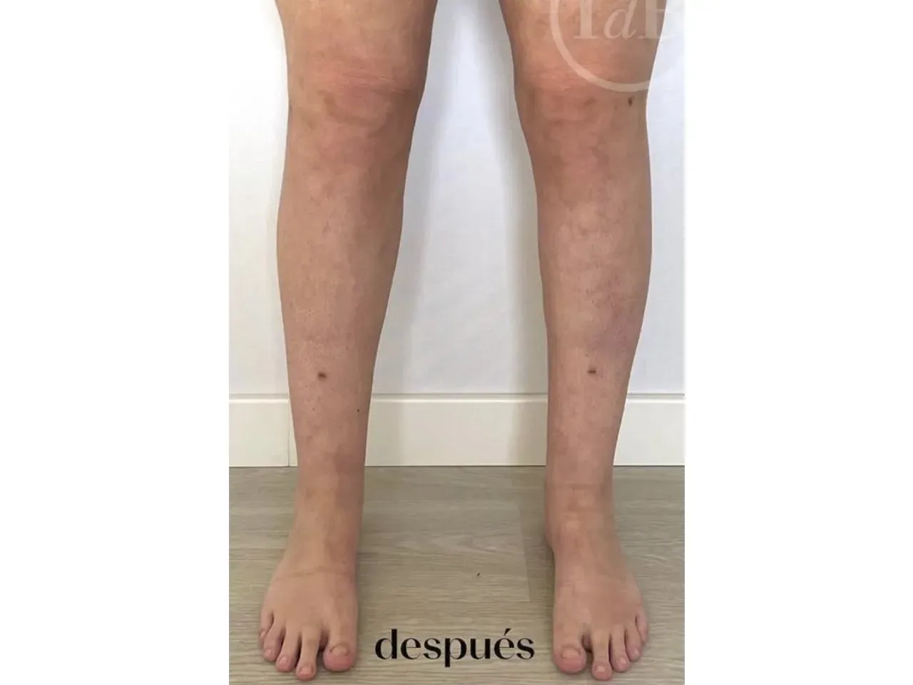 Resultado de cirugía de lipedema tras operación