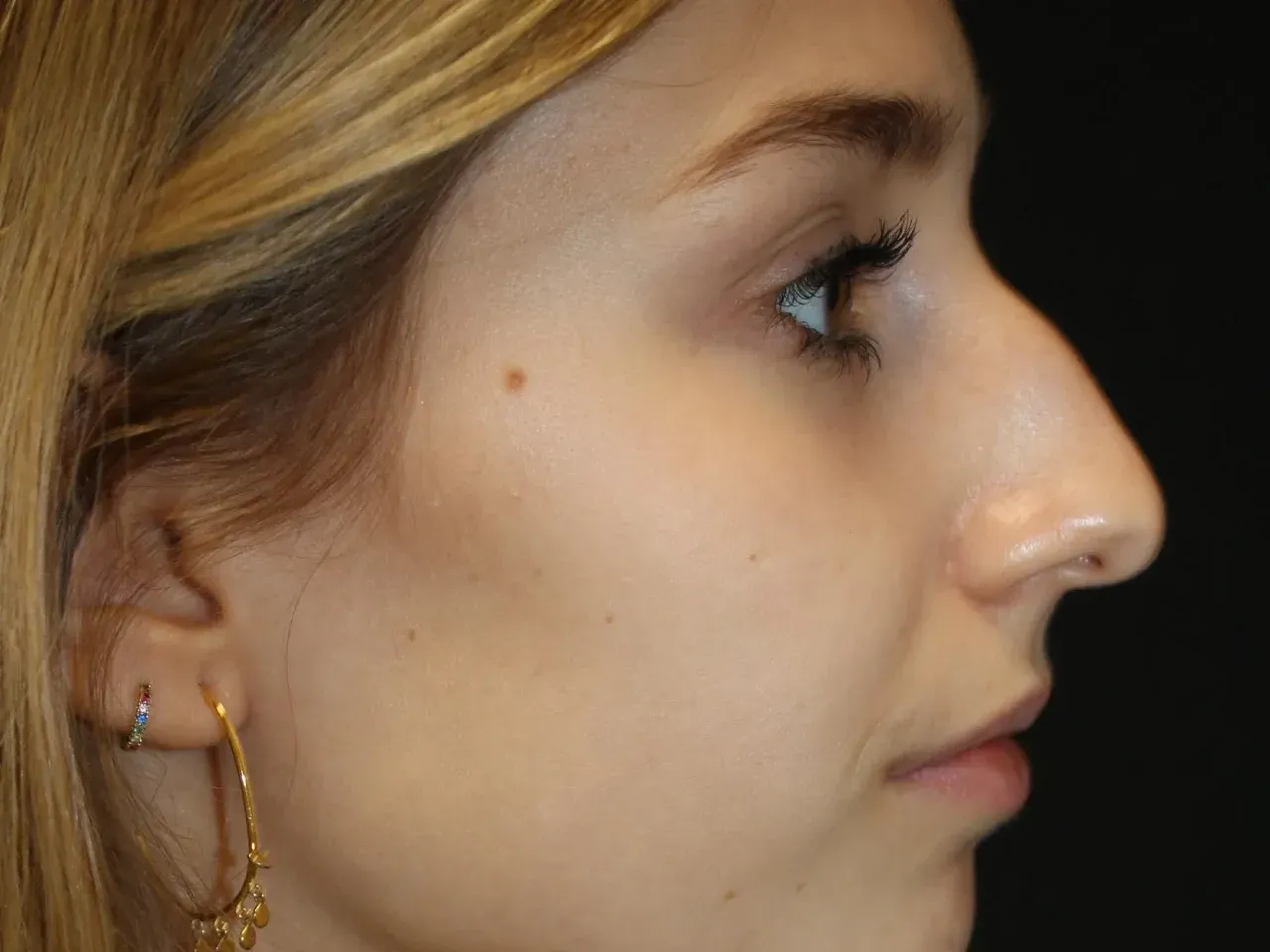 Ana rinoplastia pre