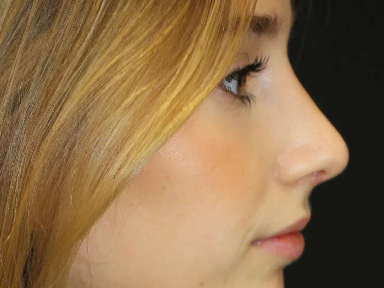 Ana rinoplastia post