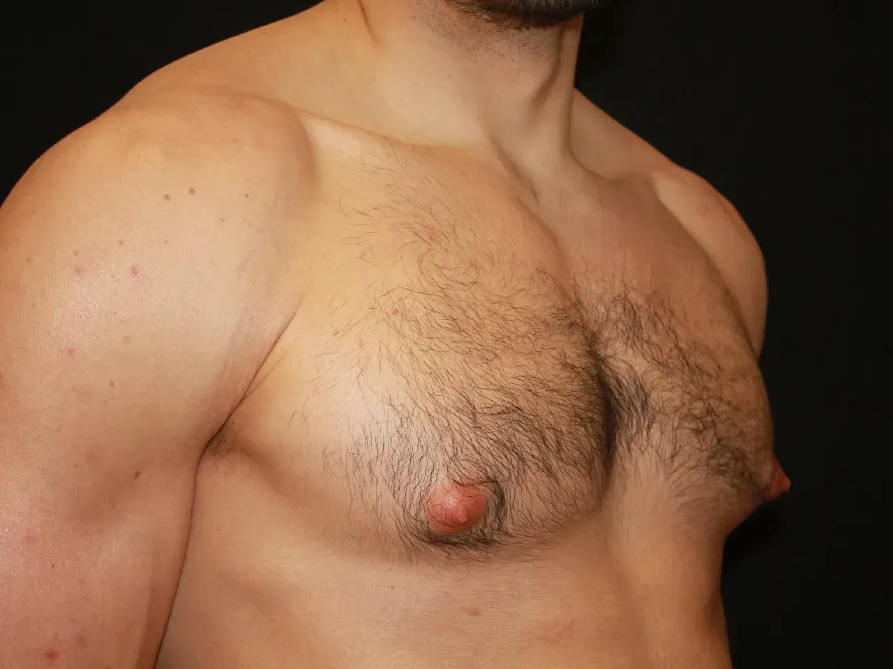 Paciente con ginecomastia masculina antes de la operación