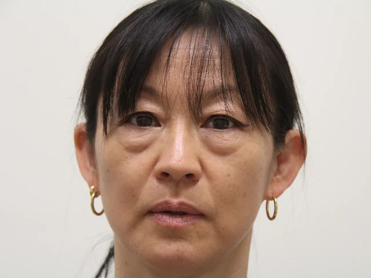 blefaroplastia completa antes