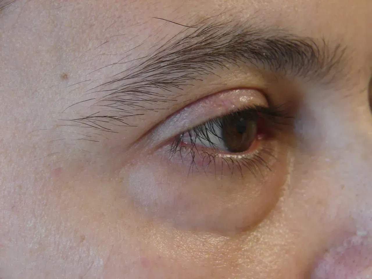 blefaroplastia inferior antes