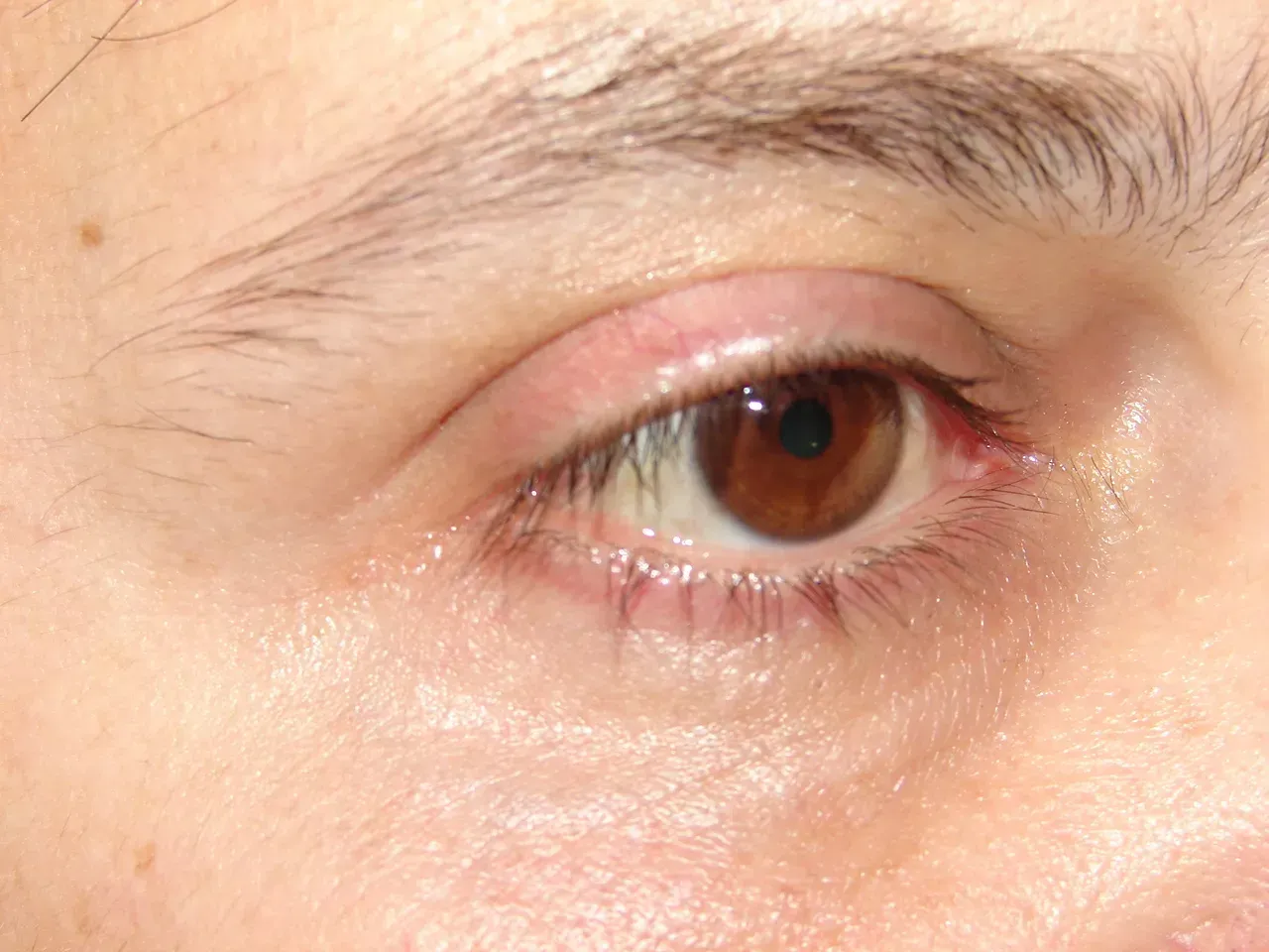 blefaroplastia inferior después