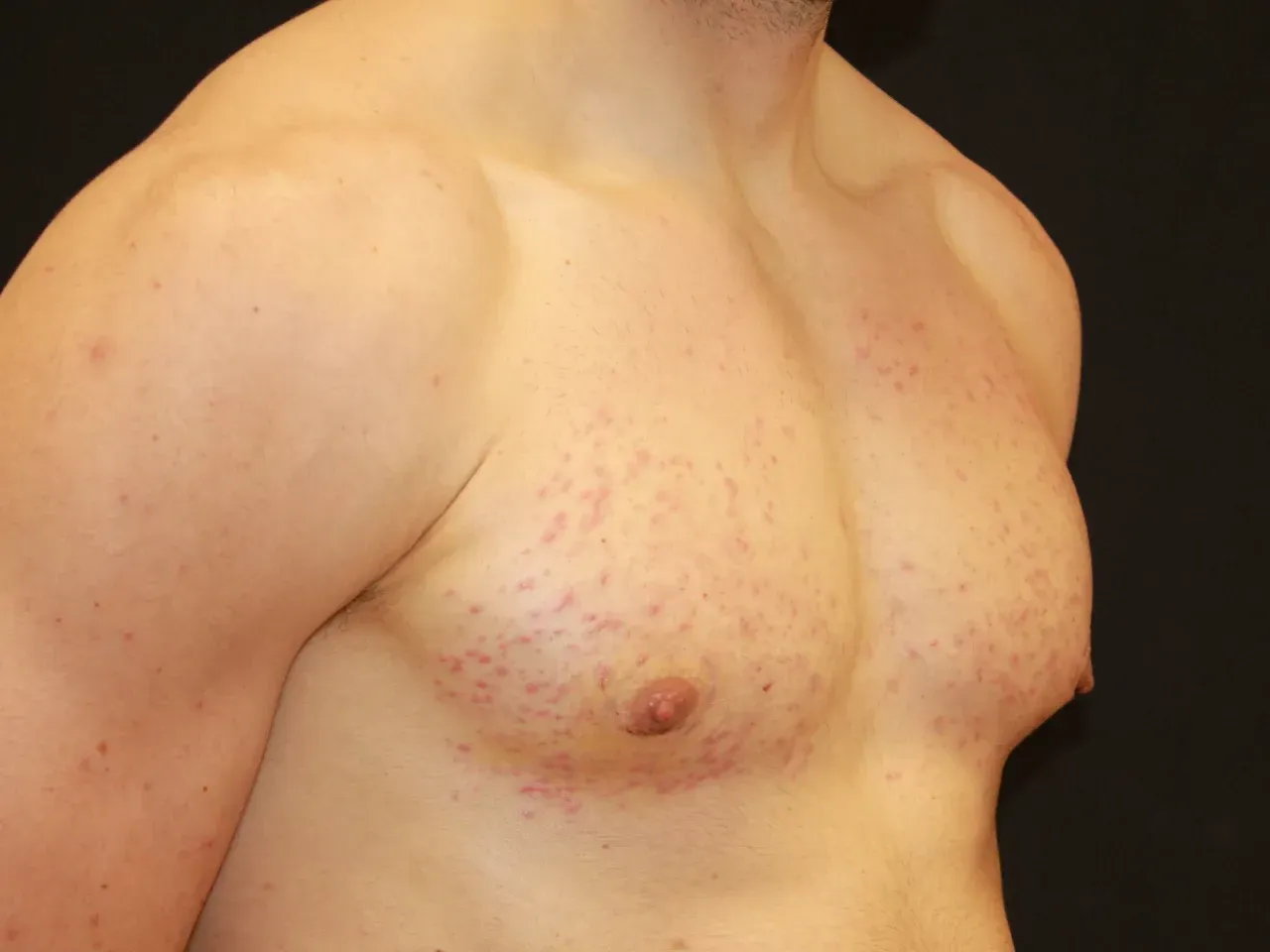 Paciente con ginecomastia masculina después de la operación