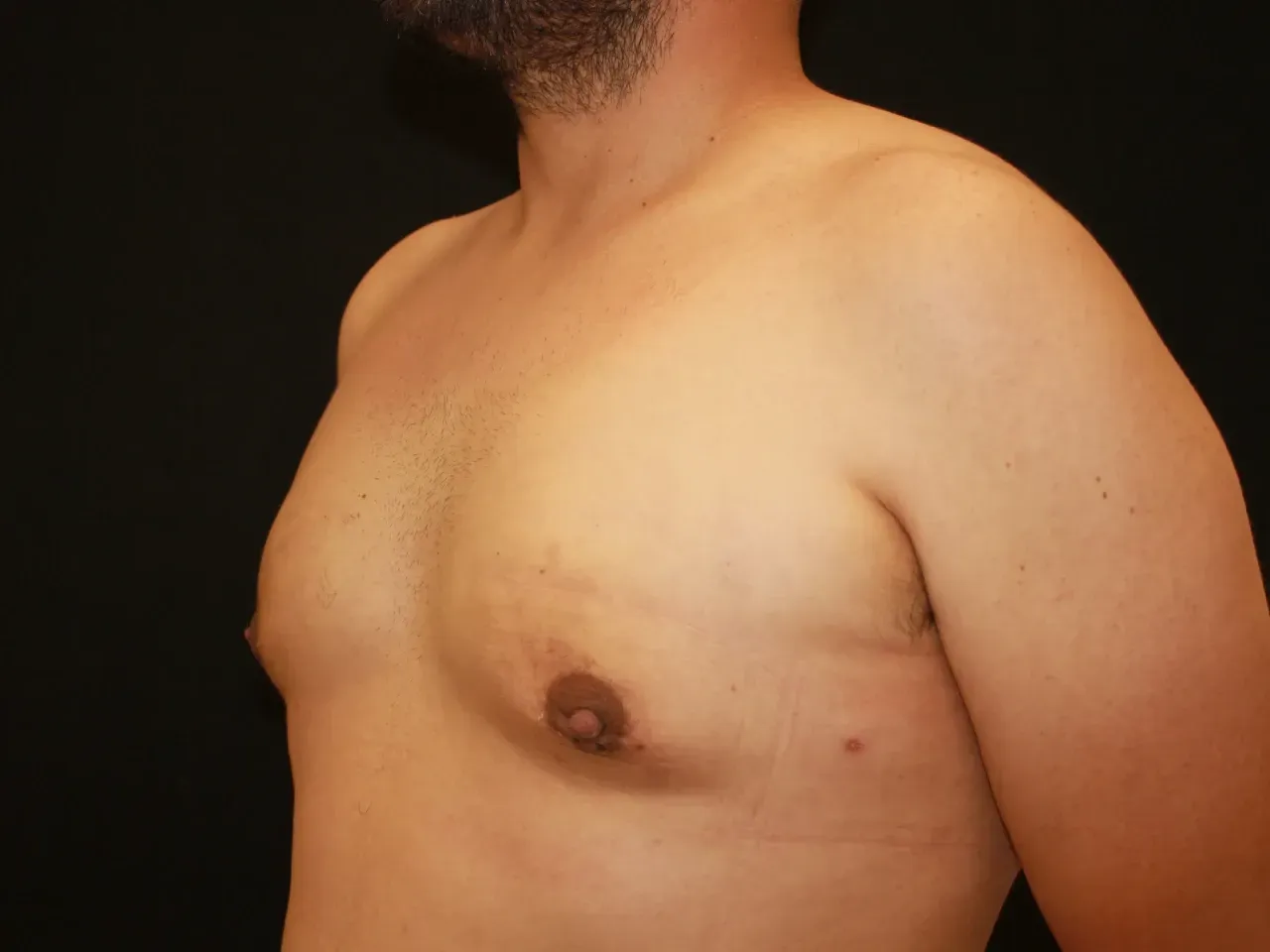Paciente con ginecomastia masculina después de ser intervenido