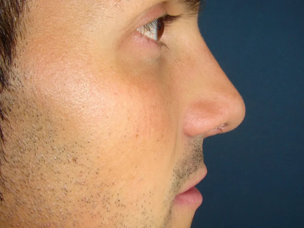 Antes: Ignacio open rhinoplasty ✨