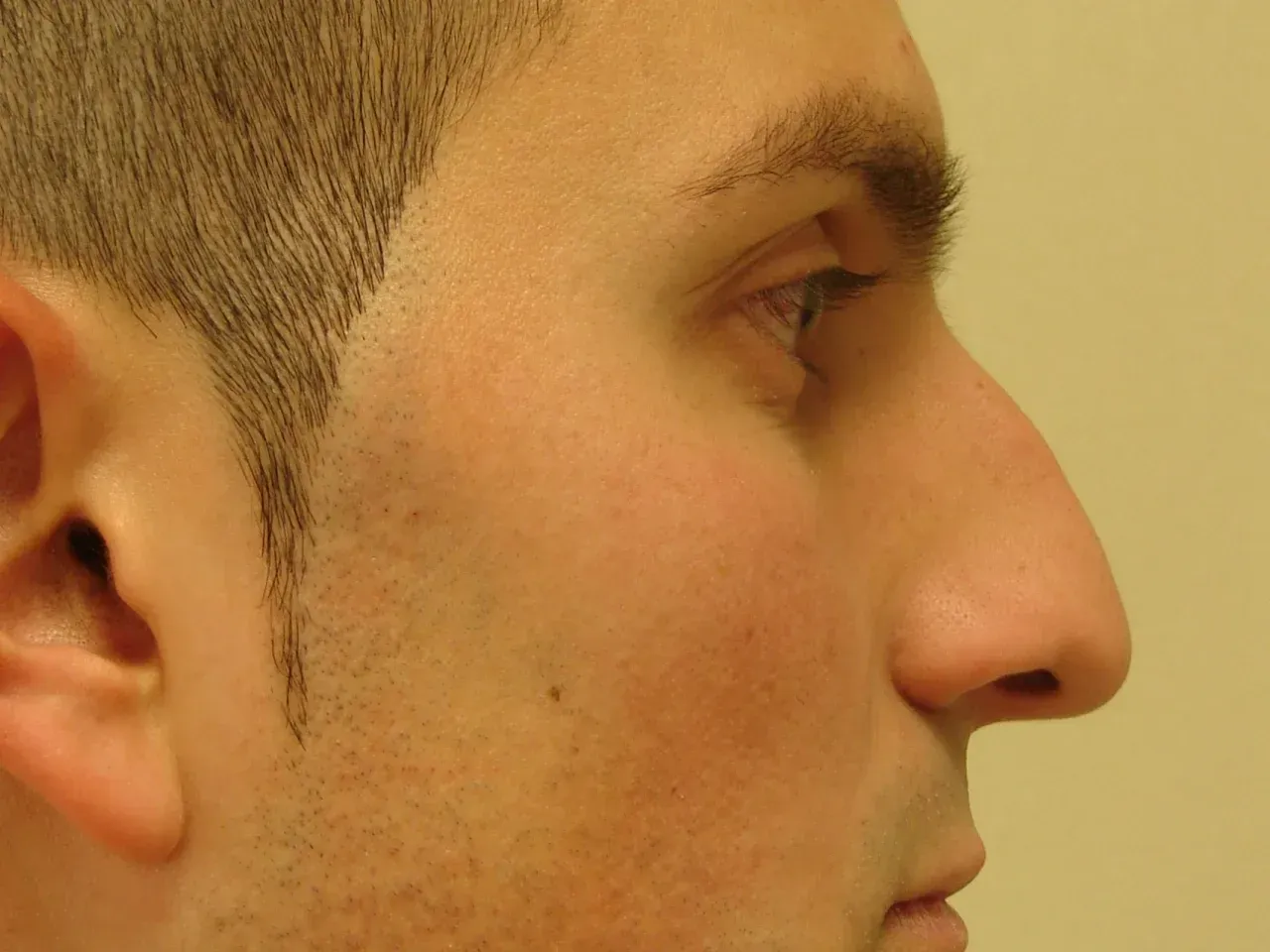 Después: Ignacio open rhinoplasty ✨
