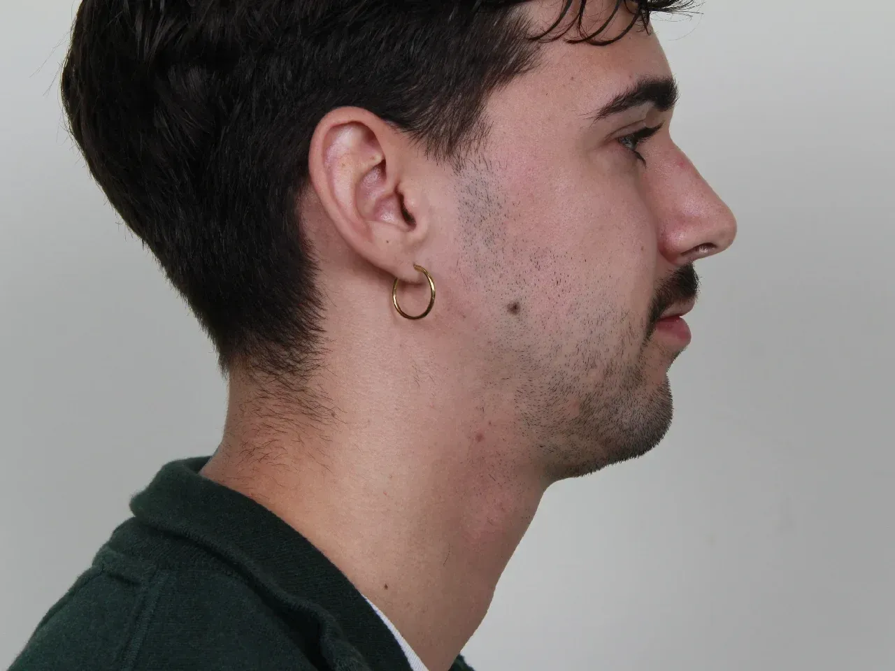 julien mentoplastia antes
