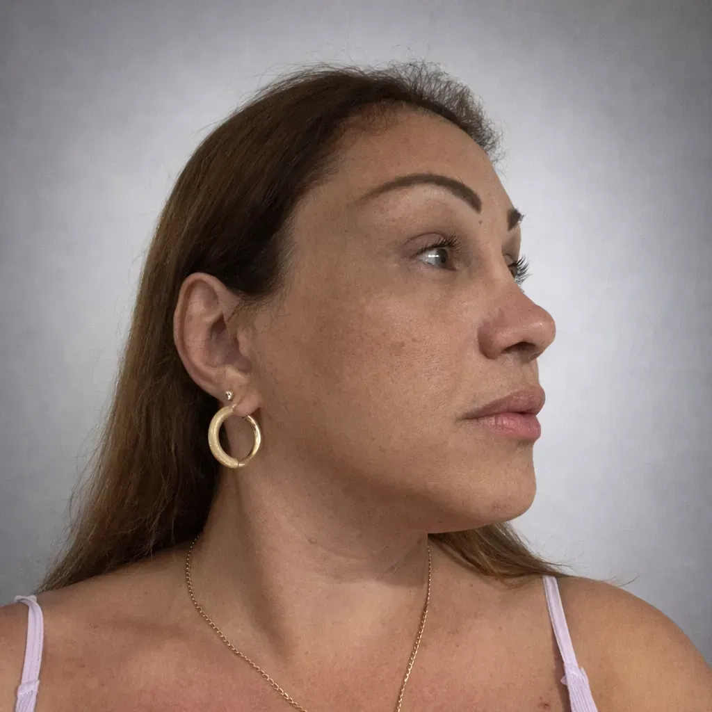 Diana feminizacion facial después