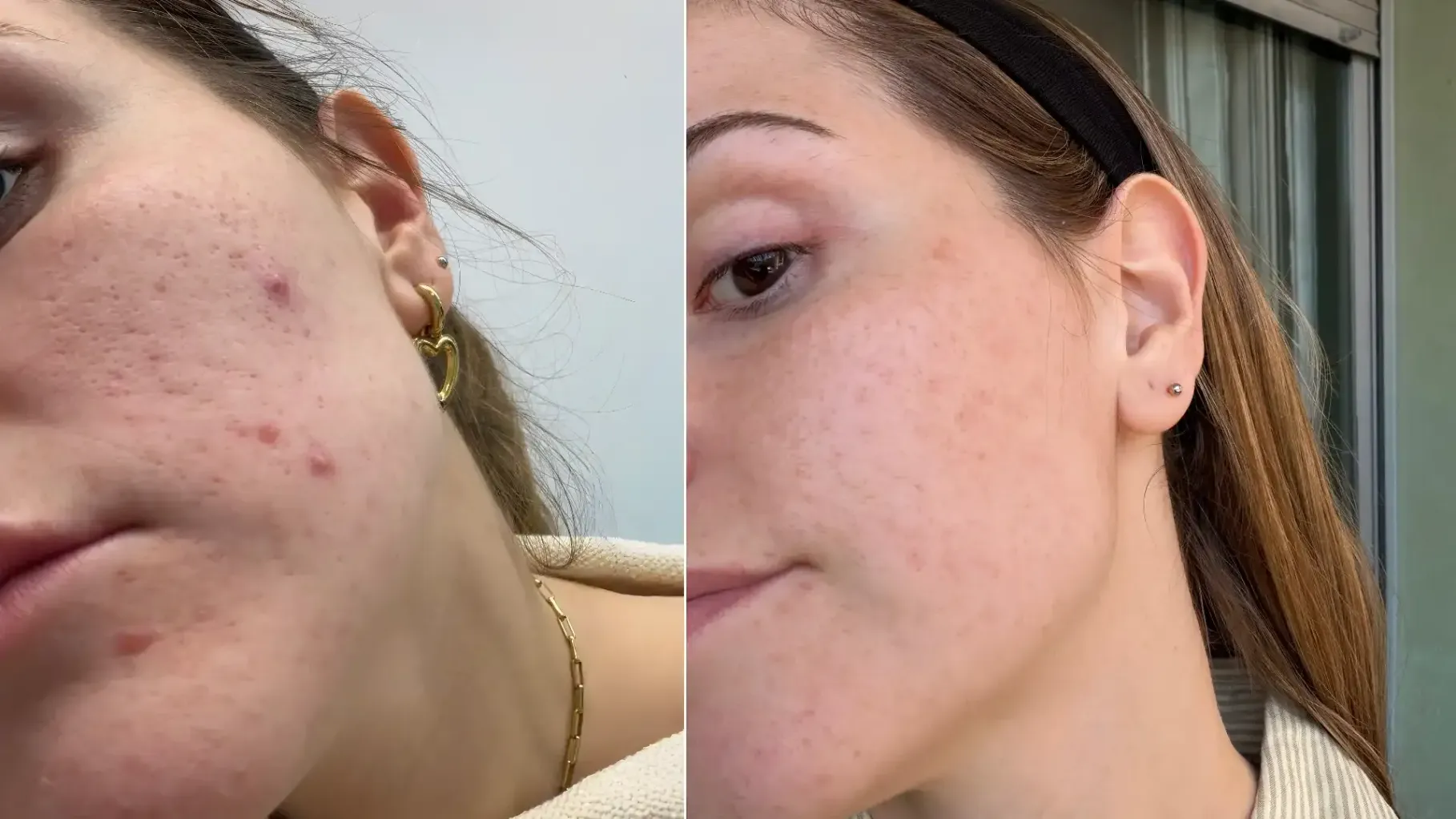 Tratamiento laser fraccionado para manchas de acné en la cara
