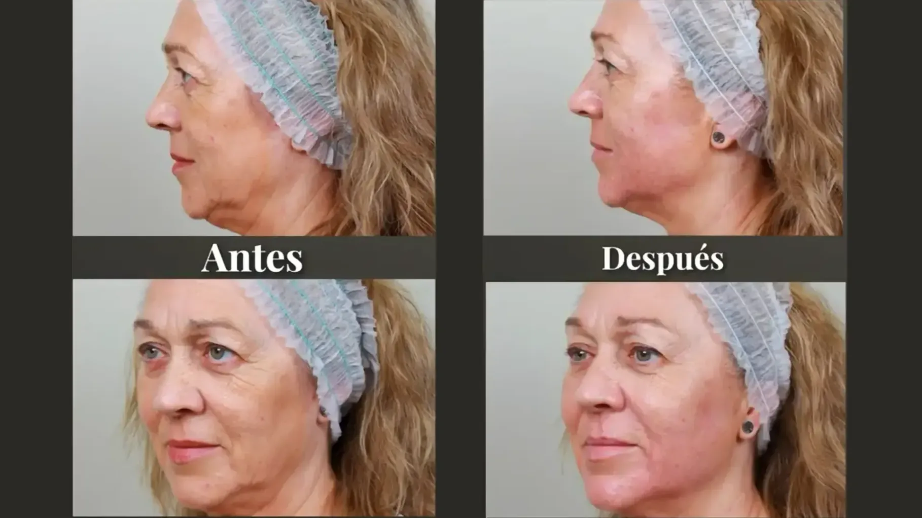 foto de antes y después de nuance de Montse