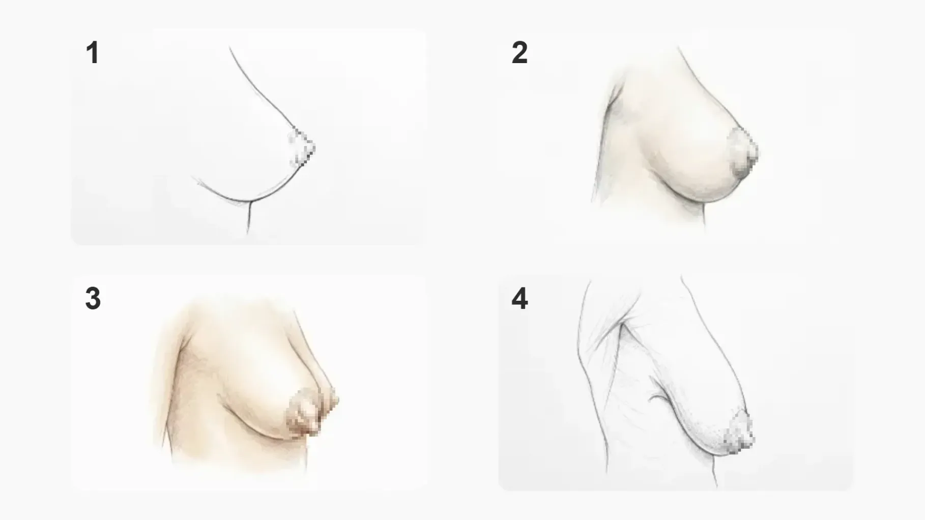 grados de mamas tuberosas