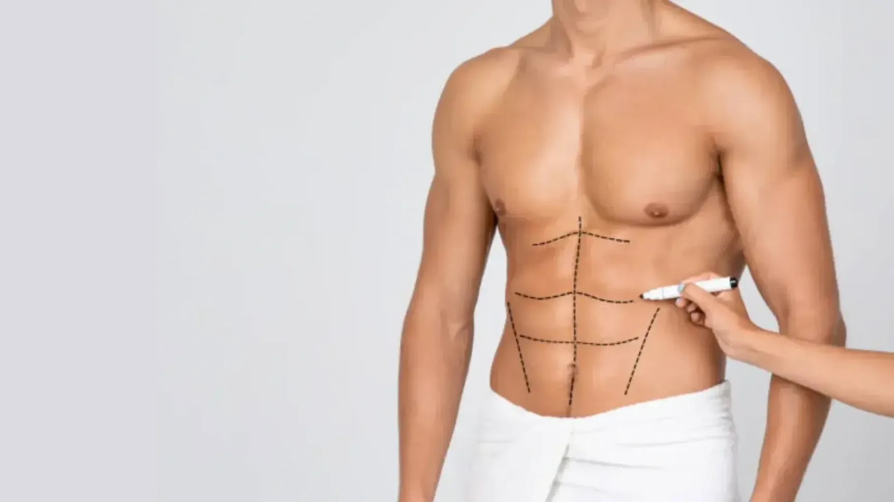 Marcaje quirúrgico en el abdomen de un hombre antes de una liposucción