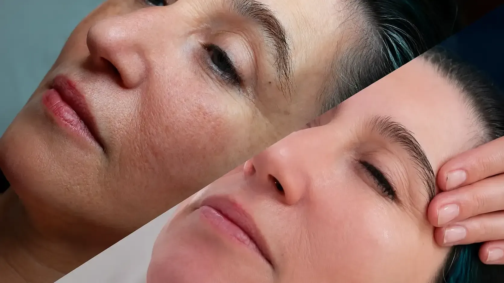 Antes y después de Nunance wellness en Barcelona