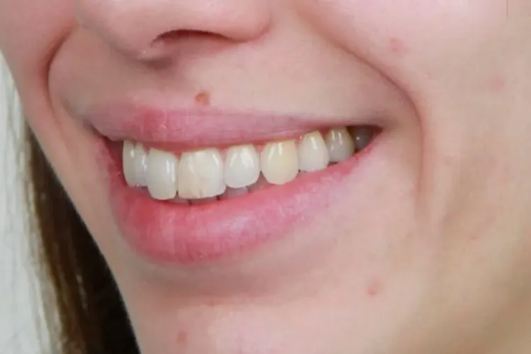 Antes