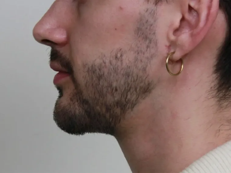 Antes