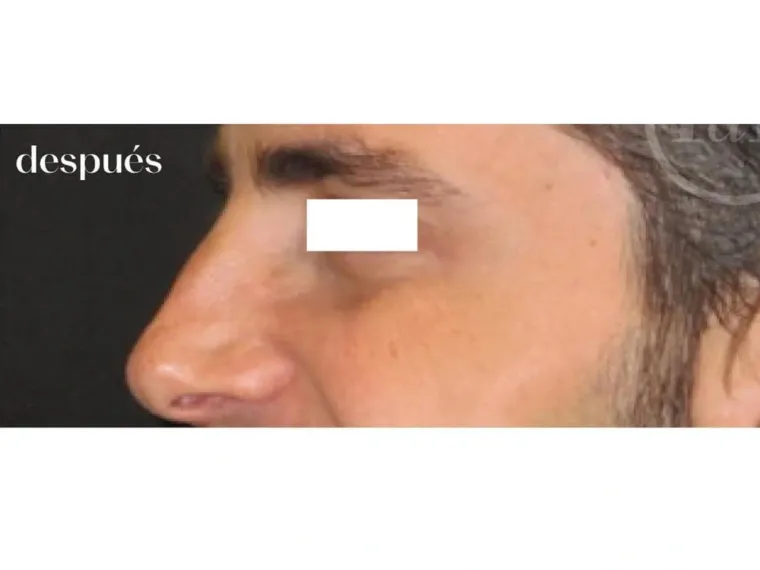 Antes