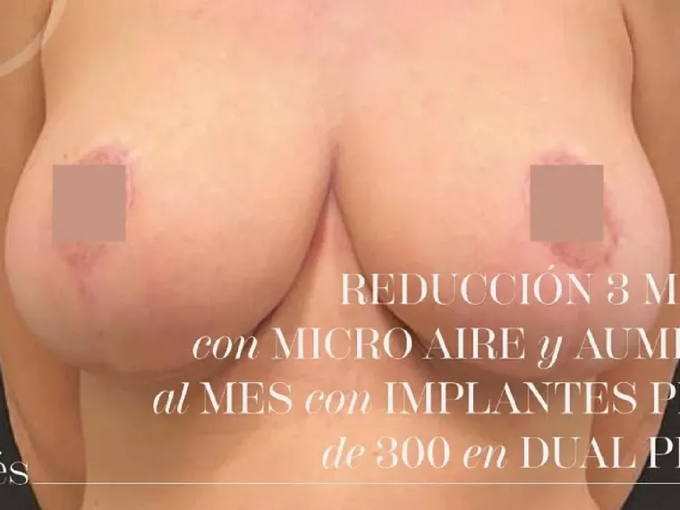 Antes
