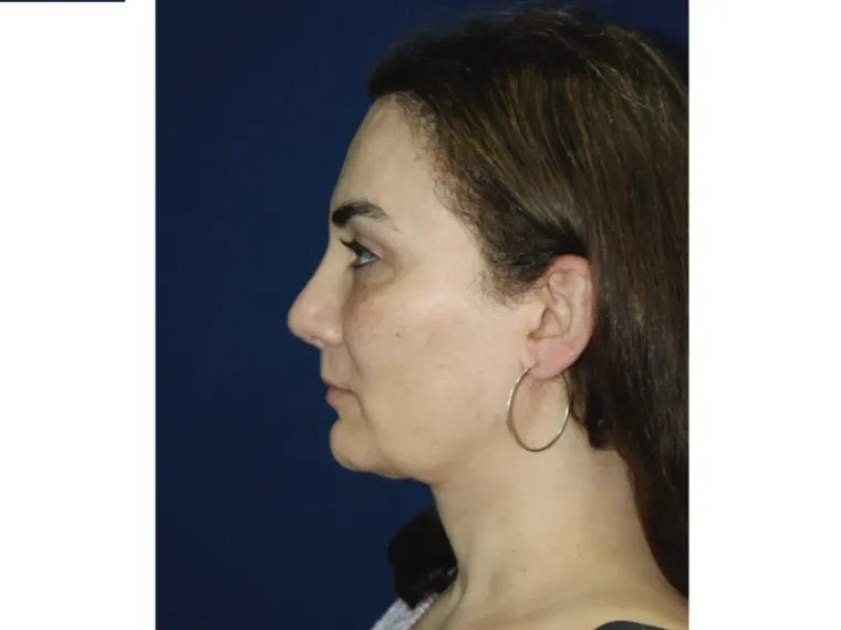 Antes