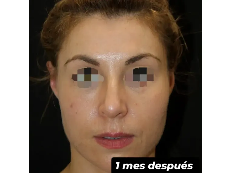 Antes