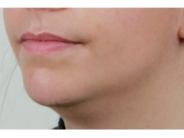 Antes