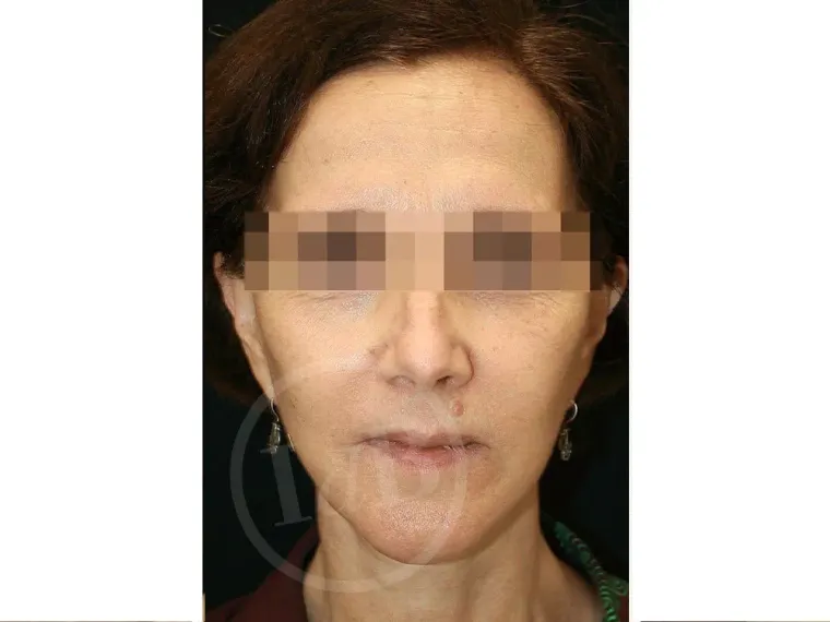 Antes