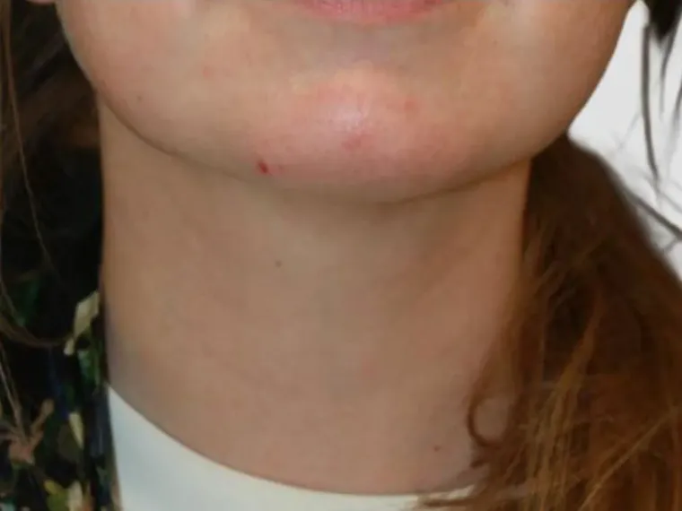 Antes