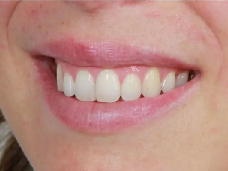 Antes