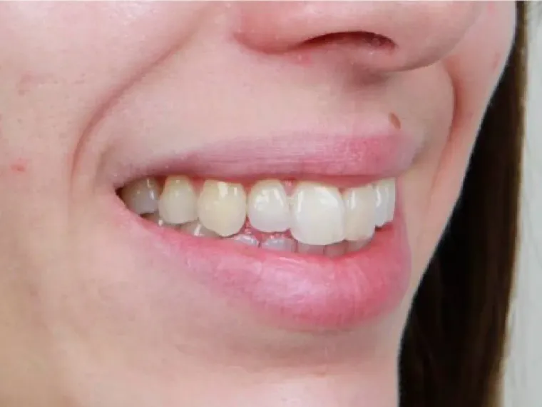 Antes