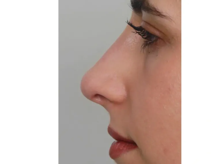 Antes
